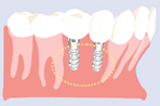 インプラント体だけで、失った歯の替わりになります。ご自分の歯と替わらなく噛んでいただけます